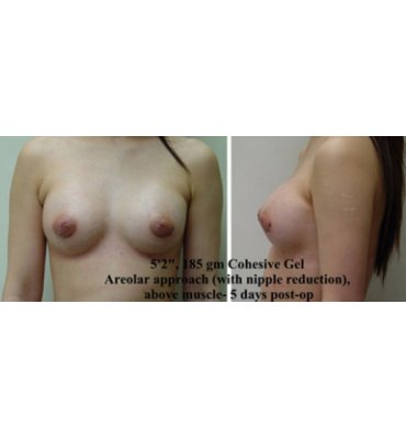 After Nipple Reduction